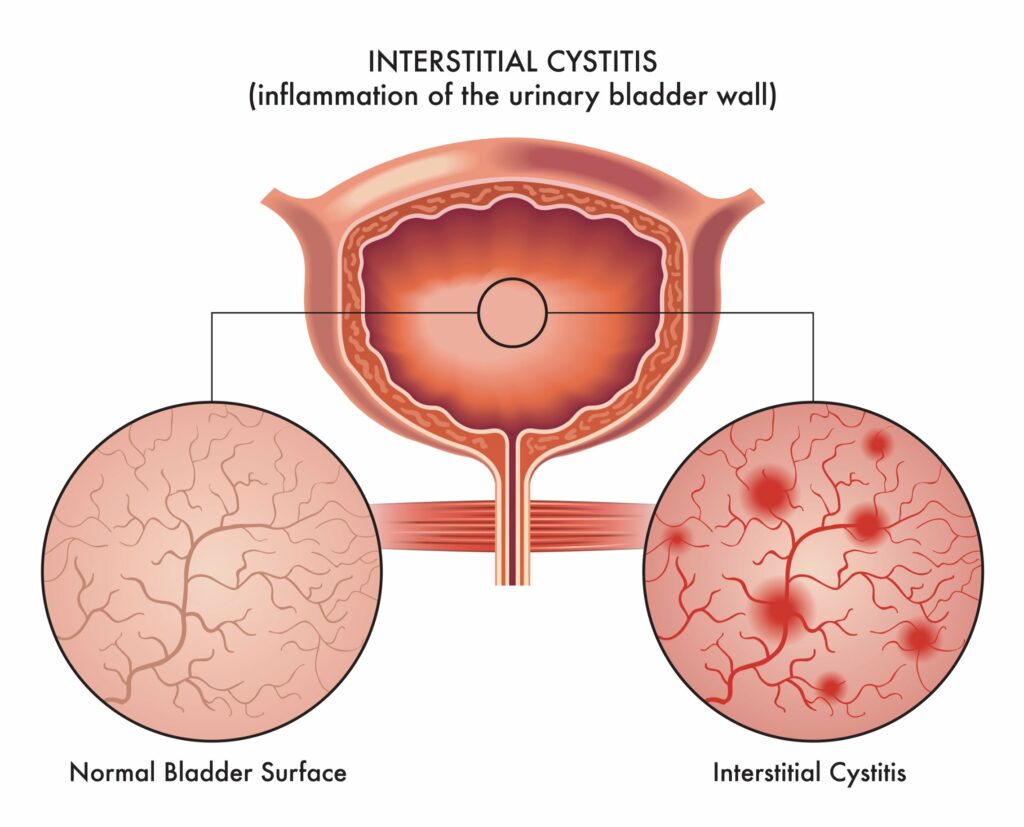 ⭐ Cystite interstitielle : pensez à l'ostéopathie !